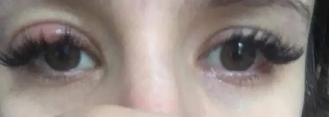 Uczulenie na tusz do rzęs objawy – jak je rozpoznać i unikać?