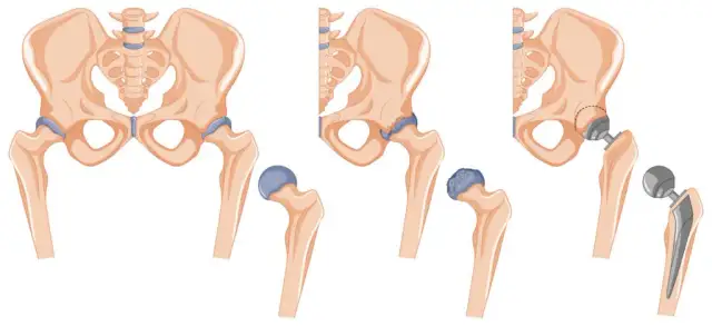 Obluzowanie endoprotezy stawu biodrowego objawy, które powinny niepokoić