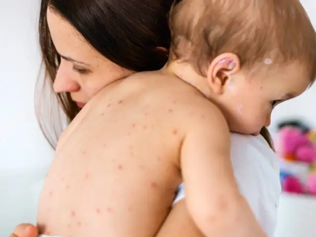 W czym kąpać dziecko z ospą? Sprawdzone sposoby na ulgę