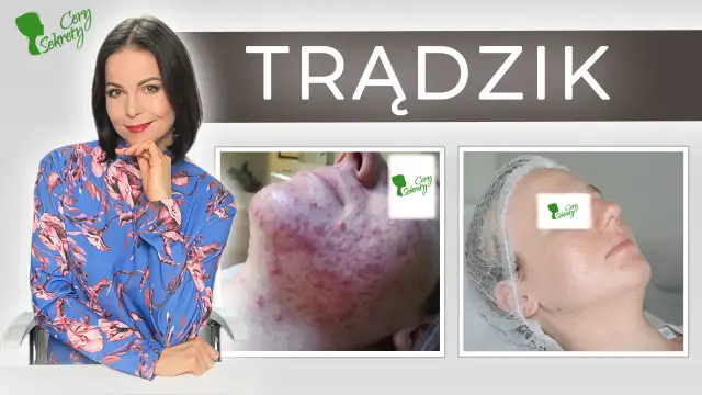 Od czego wychodzą pryszcze? Sekrety czystej cery poznaj je!