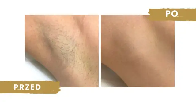 Depilacja laserowa co 2 tygodnie? Dlaczego to błąd i co robić?