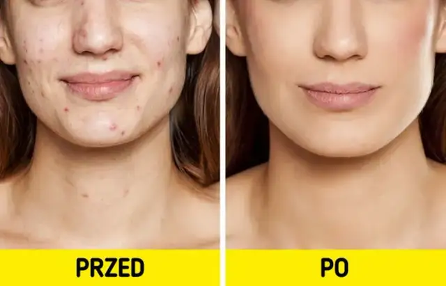 Jak pozbyć się pryszczy w kilka godzin - skuteczne i szybkie metody