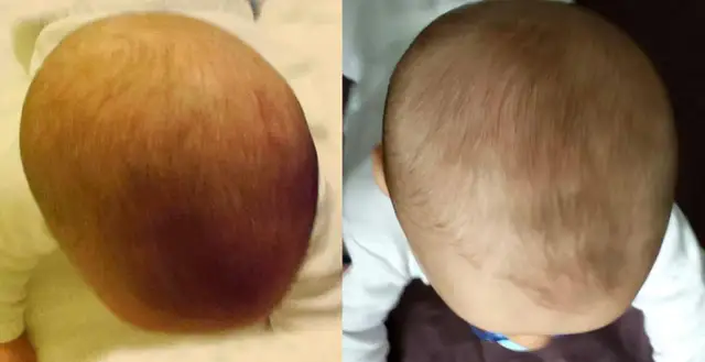 Head Care: Po jakim czasie poduszka skoryguje spłaszczoną główkę?