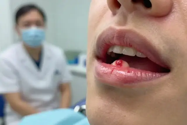 Rana na dziąśle: jak leczyć i kiedy iść do dentysty?