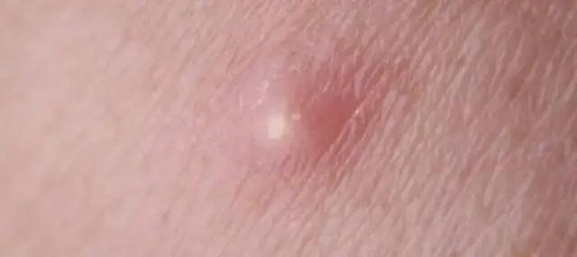 Czyrak czy pryszcz: jak je odróżnić i skutecznie leczyć?