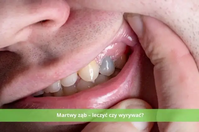 Martwy ząb: leczyć czy usunąć? Co wybrać? Koszty i zdrowie