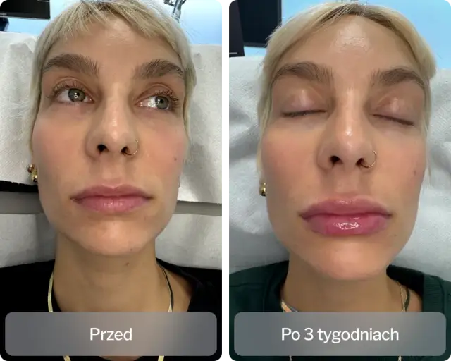 Kiedy efekt po kwasie hialuronowym? Oczekiwane rezultaty i czas działania