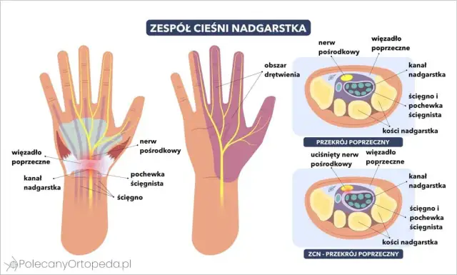 Mrowienie ręki? Cieśnia nadgarstka: Kto diagnozuje, jak leczyć?