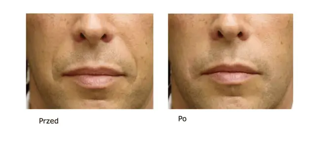 Co daje kwas hialuronowy? Odkryj jego niesamowite korzyści dla skóry