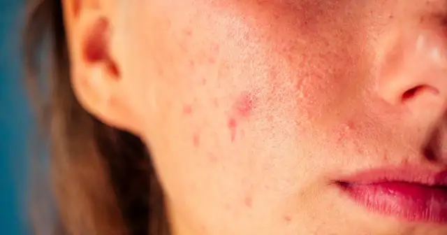 Jak pozbyć się pryszczy? Sprawdzone metody i porady ekspertów