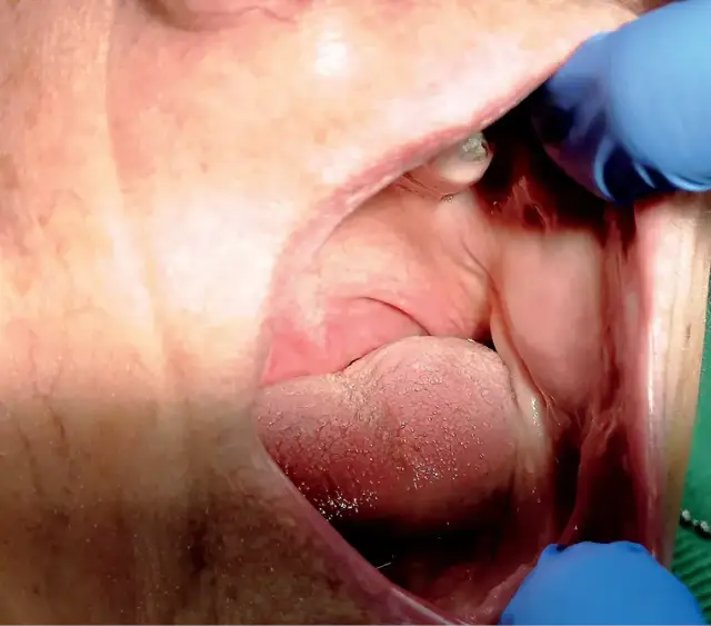 Włókniak jamy ustnej objawy: co powinieneś wiedzieć o zmianach?