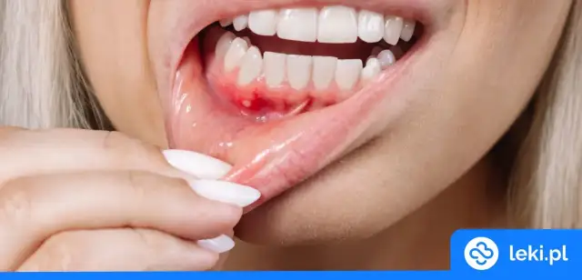 Opuchnięte dziąsła: Domowe sposoby, które działają! Kiedy do dentysty?