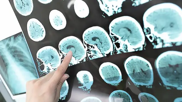 Czy ból głowy przed udarem? Poznaj objawy i kiedy dzwonić po pomoc