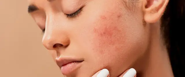 Cera trądzikowa: Jak poprawić? Pielęgnacja, dieta, zabiegi to klucz