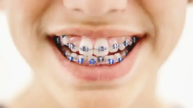 Kiedy aparat stały dla dziecka? Ortodonta radzi: wiek, koszty, proces