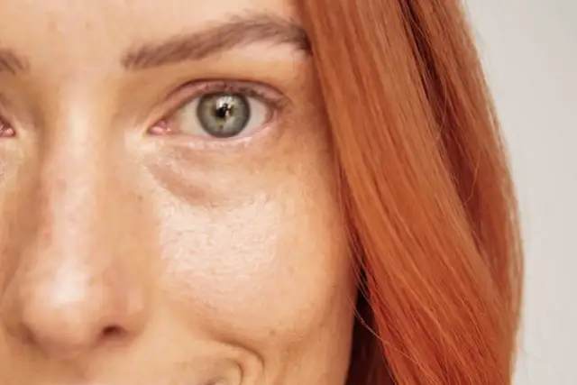 Podkrążone oczy: najczęstsze przyczyny i jak ich unikać