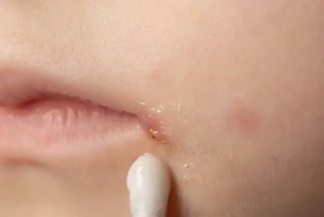 Usta dziecka z zaczerwienieniem i strupkami przy kąciku, widoczny patyczek higieniczny z maścią. To mogą być zajady u dziecka.