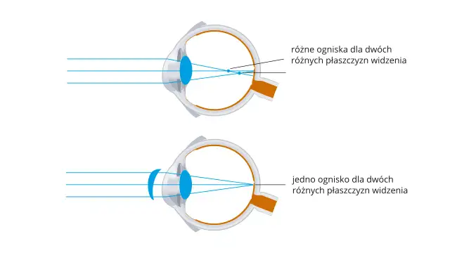 Korekcja krótkowzroczności: Jak działają soczewki rozpraszające?