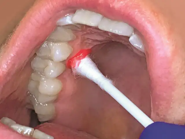 Aplikacja żelu znieczulającego na dziąsło w jamie ustnej za pomocą patyczka.