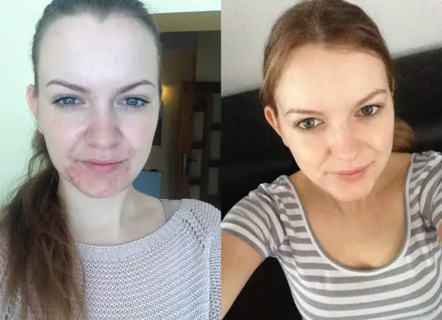 Skutki uboczne axotret: co musisz wiedzieć o działaniach niepożądanych