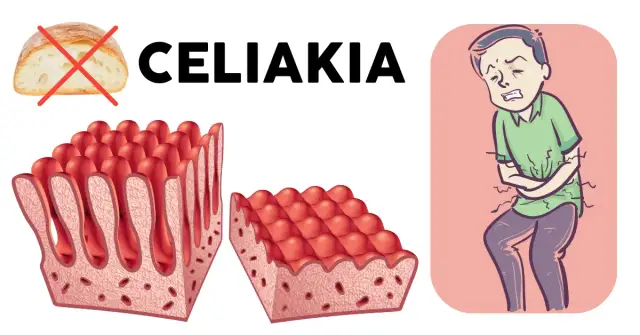 Celiakia, alergia, NCNG: co gluten robi w organizmie? Ekspert wyjaśnia