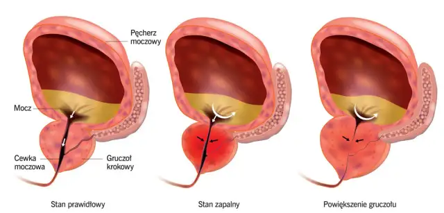 Prostata w jakim wieku powinieneś zacząć badania, aby uniknąć ryzyka