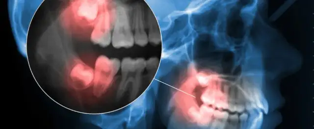 Czy ósemki rosną na górze? Odkryj prawdę o zębach mądrości