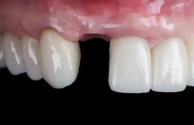 Krwawienie po wyrwaniu zęba: Ile trwa? Jak tamować? Kiedy do dentysty?