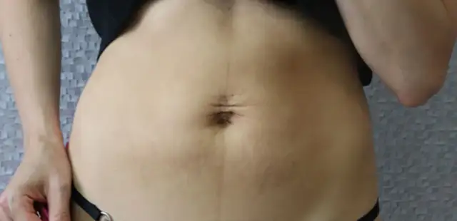 Jak skutecznie zlikwidować rozstępy po ciąży: 8 sprawdzonych metod