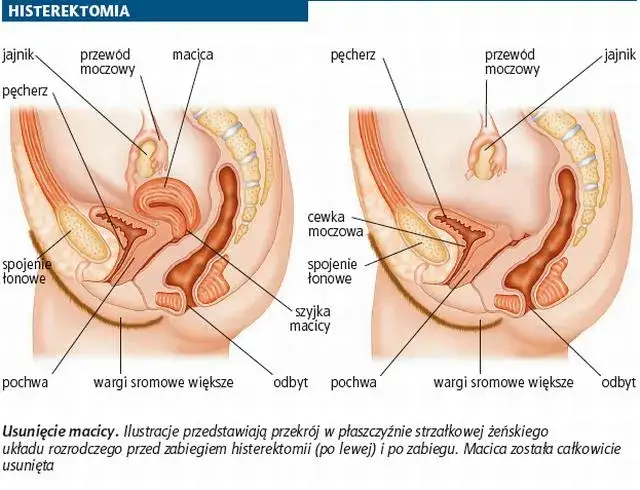 Histerektomia a miesiączka: Koniec okresu? Zrozum swoje ciało