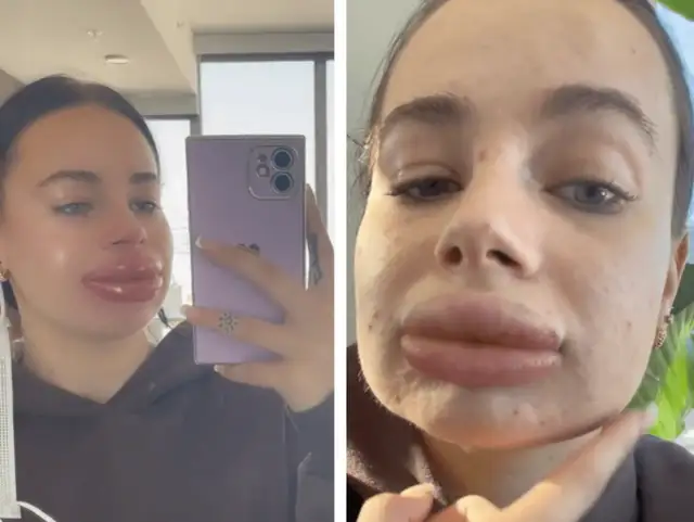 Jak zmniejszyć obrzęk po powiększaniu ust? Skuteczne porady eksperta