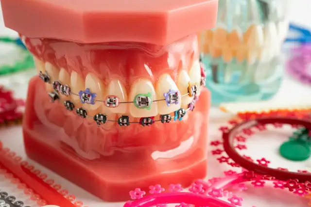 Dofinansowanie na aparat ortodontyczny: Kto ma szansę na wsparcie?