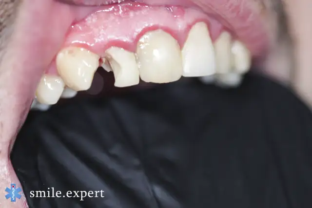 Ukruszona jedynka? Ile kosztuje odbudowa? Porównaj metody i ceny