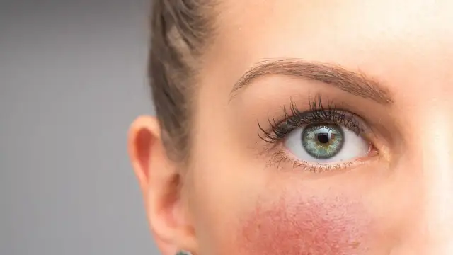 Trockene, entzündete Gesichtshaut: Der Weg zu gesunder Haut