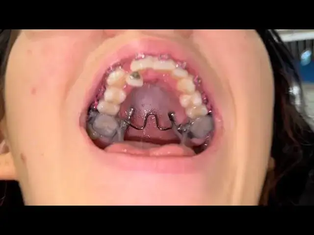 Jak przekręcać aparat Hassa, aby uniknąć bólu i uszkodzeń?