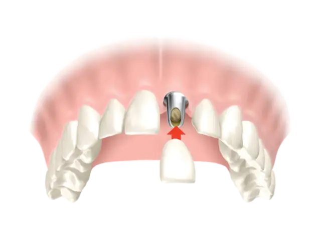 Korony zębowe: Jak wyglądają, kiedy są potrzebne i jak przebiega zakładanie?