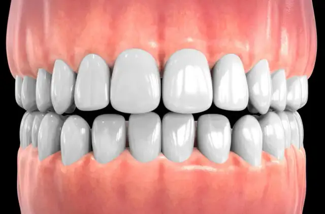 Skuteczne metody na stan zapalny dziąseł - jak uniknąć bólu i problemów