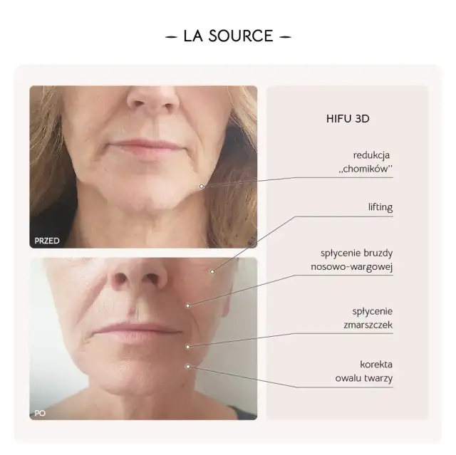 Zabiegi na szyję po 50.: HIFU, RF, stymulatory co wybrać?