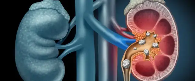 Skuteczne sposoby na ból nerek bez recepty – ulga bez wizyty u lekarza