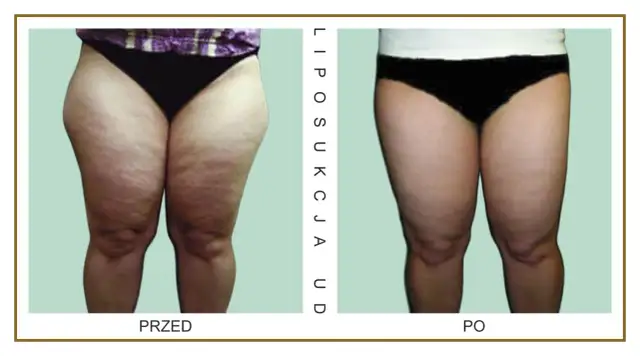 Liposukcja ud: Ile kosztuje i od czego zależy cena?