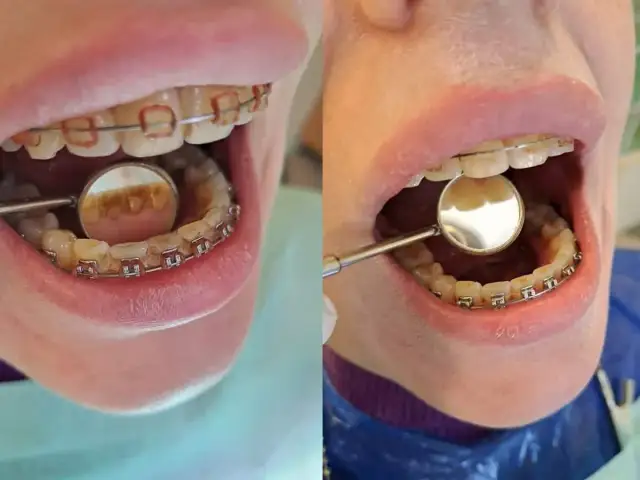 Przed i po czyszczeniu zębów z aparatem ortodontycznym. Widać wyraźną różnicę w usunięciu kamienia nazębnego.