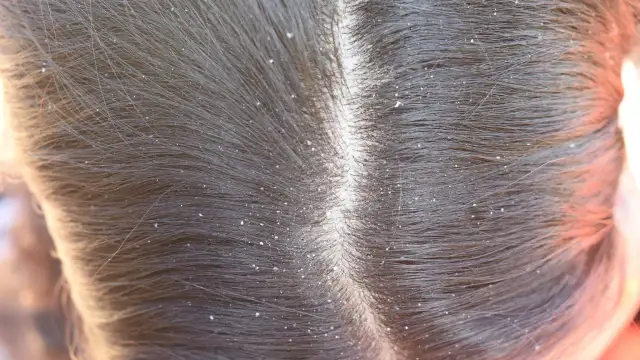 Masz łupież? Jak zwalczyć go domowymi sposobami - Naturalne metody