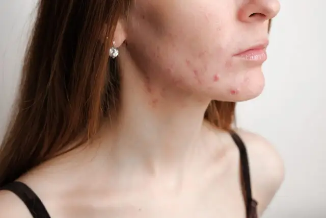 Od czego wychodzą pryszcze? Poznaj 10+ przyczyn i znajdź rozwiązanie!