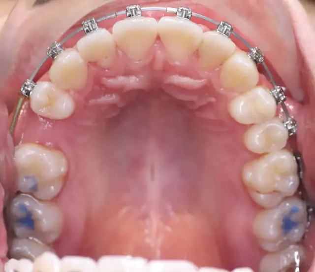 Leczenie jednego łuku: czy to się opłaca i kiedy ma sens?