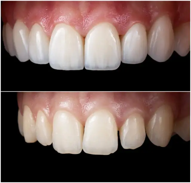 Bonding zębów: Jak działa, ile kosztuje i czy to dla Ciebie?