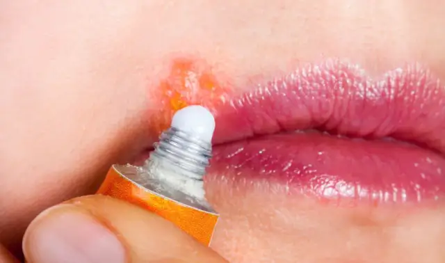 Skuteczne leki na opryszczkę - co wybrać, aby szybko wyleczyć?