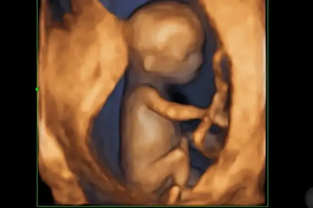 Kiedy zrobić badania prenatalne, aby uniknąć nieprawidłowości?