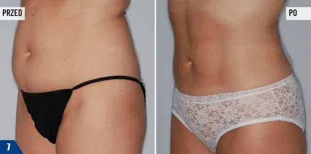 Liposukcja laserowa: Cena, ukryte koszty i jak sfinansować?