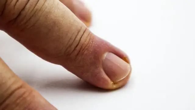 Jak skutecznie leczyć zszedły paznokieć i czym smarować?