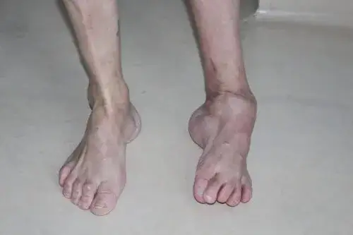 Heine Medina objawy - jak rozpoznać chorobę i uniknąć powikłań